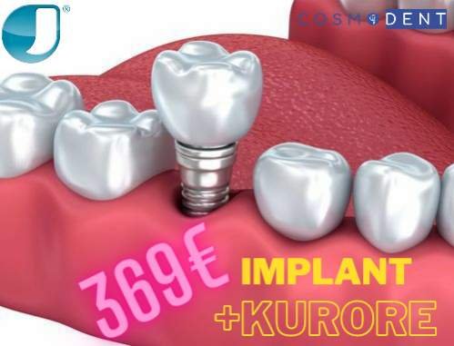 Tirane, oferte Implante dentare sherbime dentare 369 Euro